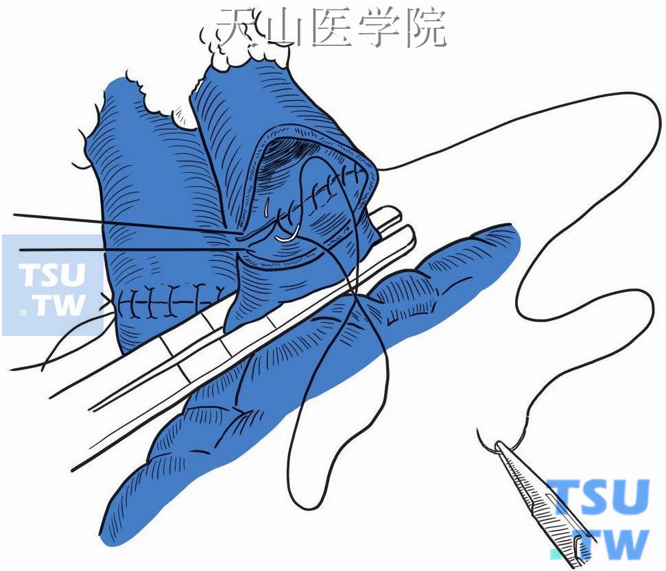 泌尿外科手术图像与解剖_泌尿外科手术彩色图解_《泌尿外科手术图谱》